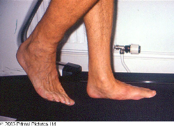 flat feet